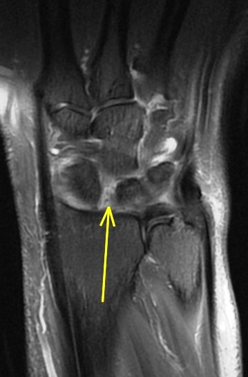 Figure 4 for case scapholunate ligament tear ( RID2259 )